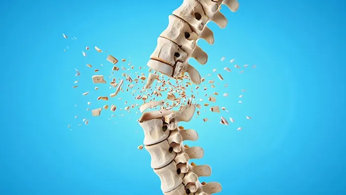 osteoporosis